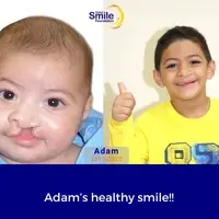 Before and after photos of a young boy who received cleft care