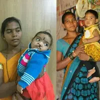 Free Cleft Surgery for underserved populations