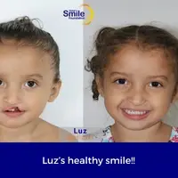 Before and after photos of a young girl who received cleft care